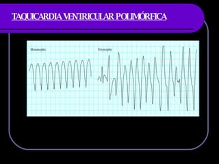 TAQUICARDIA VENTRICULAR POLIMÓRFICA 