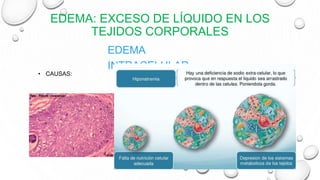 EDEMA: EXCESO DE LÍQUIDO EN LOS
TEJIDOS CORPORALES
EDEMA
INTRACELULAR
• CAUSAS:
 