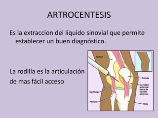 ARTROCENTESISEs la extraccion del líquidosinovialquepermiteestablecer un buendiagnóstico.La rodillaes la articulaciónde masfácilacceso