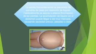 La ascitis frecuentemente va precedido de
aumento de peso por retención de líquido.
Habitualmente se asocia a edema (hinchazón)
de las piernas. La acumulación de líquido en el
abdomen puede llegar a ser muy marcada,
causando saciedad precoz, pesadez o dolor.
 