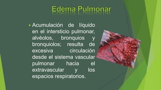  Acumulación de líquido
en el intersticio pulmonar,
alvéolos, bronquios y
bronquiolos; resulta de
excesiva circulación
desde el sistema vascular
pulmonar hacia el
extravascular y los
espacios respiratorios.
 