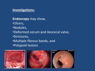 Investigations:
Endoscopy may show,
•Ulcers,
•Nodules,
•Deformed cecum and ileocecal valve,
•Strictures,
•Multiple fibrous bands, and
•Polypoid lesions
 