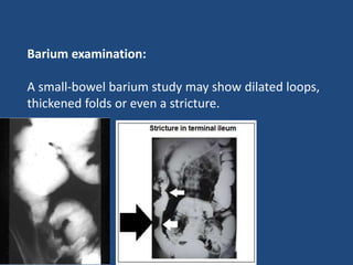 Barium examination:
A small-bowel barium study may show dilated loops,
thickened folds or even a stricture.
 