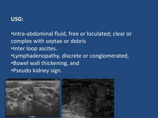USG:
•Intra-abdominal fluid, free or loculated; clear or
complex with septae or debris
•Inter loop ascites.
•Lymphadenopathy, discrete or conglomerated,
•Bowel wall thickening, and
•Pseudo kidney sign.
 