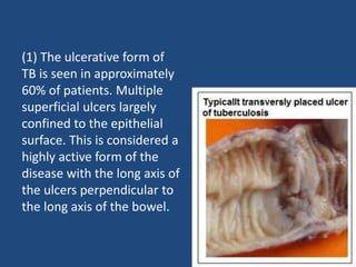 (1) The ulcerative form of
TB is seen in approximately
60% of patients. Multiple
superficial ulcers largely
confined to the epithelial
surface. This is considered a
highly active form of the
disease with the long axis of
the ulcers perpendicular to
the long axis of the bowel.
 