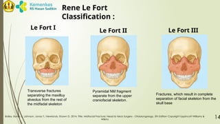 Fort Classification LR - TRAUMA OF MAXILLARY SINUSSSSSS.pptx