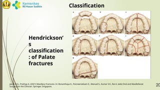 LR - TRAUMA OF MAXILLARY SINUSSSSSS.pptx