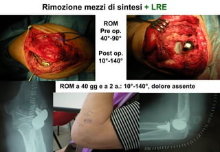 Rimozione mezzi di sintesi + LRE
ROM
Pre op.
40°-90°
Post op.
10°-140°

ROM a 40 gg e a 2 a.: 10°-140°, dolore assente

 
