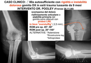 CASO CLINICO: ♂ 80a autosufficiente con rigidità e instabilità
dolorosa gomito DX in esiti trauma lussante da 9 mesi
INTERVENTO DR. POOLEY (Firenze 28.11.06)
scomparsa del dolore
riallineamento articolare e
stabilità primaria del
gomito,sono ottenuti con
protesi LRE
in lieve overstuffig ( 2,5 mm)
ROM pre op. 45°- 90°
ROM post op. 20°-140°
ALTERNATIVE: *Astensione
*Ricostruzione leg.

*Artroprotesi

 
