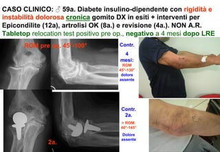CASO CLINICO: ♂ 59a. Diabete insulino-dipendente con rigidità e
instabilità dolorosa cronica gomito DX in esiti + interventi per
Epicondilite (12a), artrolisi OK (8a.) e revisione (4a.). NON A.R.
Tabletop relocation test positivo pre op., negativo a 4 mesi dopo LRE
ROM pre op. 45°-100°

Contr.
4
mesi:
ROM
45°-130°
dolore
assente

Contr.
2a.
> ROM:
40°-145°

2a.

Dolore
assente

 