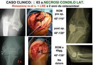 CASO CLINICO: ♀ 63 a.NECROSI CONDILO LAT.
Rimozione m.di s. + LRE a 2 anni da osteosintesi
ROM
pre op.
45°-110°

post op.
40°-130°

ROM a
40gg.
40°-130°
2 a.

No
dolore

 