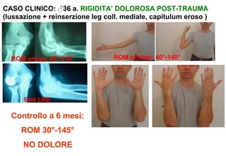 CASO CLINICO: ♂36 a. RIGIDITA’ DOLOROSA POST-TRAUMA
(lussazione + reinserzione leg coll. mediale, capitulum eroso )

ROM preop: 45°-110°

Emi LRE

Controllo a 6 mesi:
ROM 30°-145°
NO DOLORE

ROM postop: 40°-140°

 