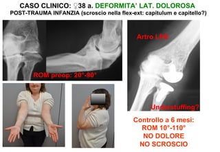 CASO CLINICO: ♀38 a. DEFORMITA’ LAT. DOLOROSA
POST-TRAUMA INFANZIA (scroscio nella flex-ext: capitulum e capitello?)

Artro LRE

ROM preop: 20°-90°

Understuffing?
Controllo a 6 mesi:
ROM 10°-110°
NO DOLORE
NO SCROSCIO

 