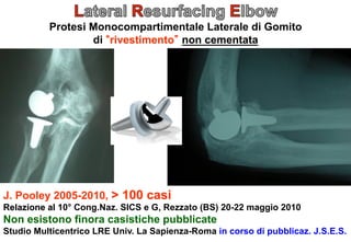 Protesi Monocompartimentale Laterale di Gomito
di rivestimento non cementata

J. Pooley 2005-2010, > 100 casi
Relazione al 10° Cong.Naz. SICS e G, Rezzato (BS) 20-22 maggio 2010

Non esistono finora casistiche pubblicate
Studio Multicentrico LRE Univ. La Sapienza-Roma in corso di pubblicaz. J.S.E.S.

 