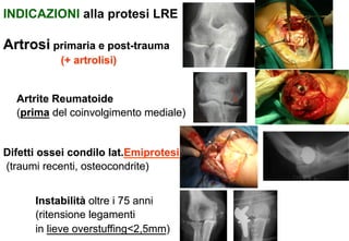 INDICAZIONI alla protesi LRE

Artrosi primaria e post-trauma
(+ artrolisi)
Artrite Reumatoide
(prima del coinvolgimento mediale)

Difetti ossei condilo lat.Emiprotesi
(traumi recenti, osteocondrite)
Instabilità oltre i 75 anni
(ritensione legamenti
in lieve overstuffing<2,5mm)

 