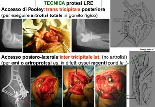 TECNICA protesi LRE
Accesso di Pooley: trans tricipitale posteriore
(per eseguire artrolisi totale in gomito rigido)
artrosica)

Lateral Head of
Triceps

Accesso postero-laterale:inter tricipitale lat. (no artrolisi)
(per emi o artroprotesi es. in difetti ossei recenti cond.lat.)

Anconeus

 
