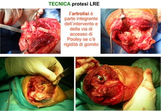TECNICA protesi LRE
l artrolisi è
parte integrante
dell intervento e
della via di
accesso di
Pooley se c’è
rigidità di gomito

 