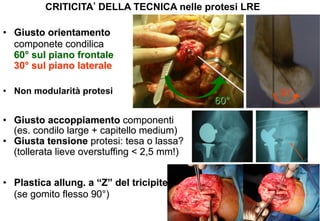 CRITICITA DELLA TECNICA nelle protesi LRE
•  Giusto orientamento
componete condilica
60° sul piano frontale
30° sul piano laterale
•  Non modularità protesi

•  Giusto accoppiamento componenti
(es. condilo large + capitello medium)
•  Giusta tensione protesi: tesa o lassa?
(tollerata lieve overstuffing < 2,5 mm!)
•  Plastica allung. a “Z” del tricipite
(se gomito flesso 90°)

60°

30°

 