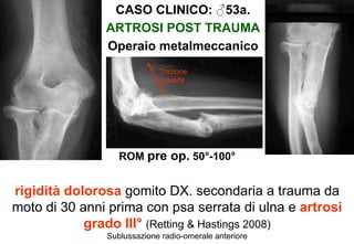CASO CLINICO: ♂53a.
ARTROSI POST TRAUMA
Operaio metalmeccanico
Trazione
bicipite

ROM pre op. 50°-100°

rigidità dolorosa gomito DX. secondaria a trauma da
moto di 30 anni prima con psa serrata di ulna e artrosi
grado III° (Retting & Hastings 2008)
Sublussazione radio-omerale anteriore

 