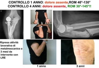 CONTROLLO 1 ANNO: dolore assente,ROM 40°-130°
CONTROLLO 4 ANNI: dolore assente, ROM 30°-145°!!

Ripresa attività
lavorativa di
metalmeccanico a
3 mesi da
intervento con
LRE

1 anno

3 anni

 