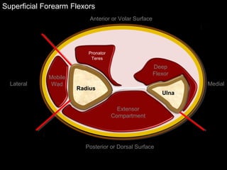 Superficial Forearm Flexors
Ulna
Radius
Extensor
Compartment
Mobile
Wad
Deep
Flexor
Pronator
Teres
Anterior or Volar Surface
Posterior or Dorsal Surface
Lateral Medial
 