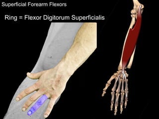 Superficial Forearm Flexors
Ring = Flexor Digitorum Superficialis
 