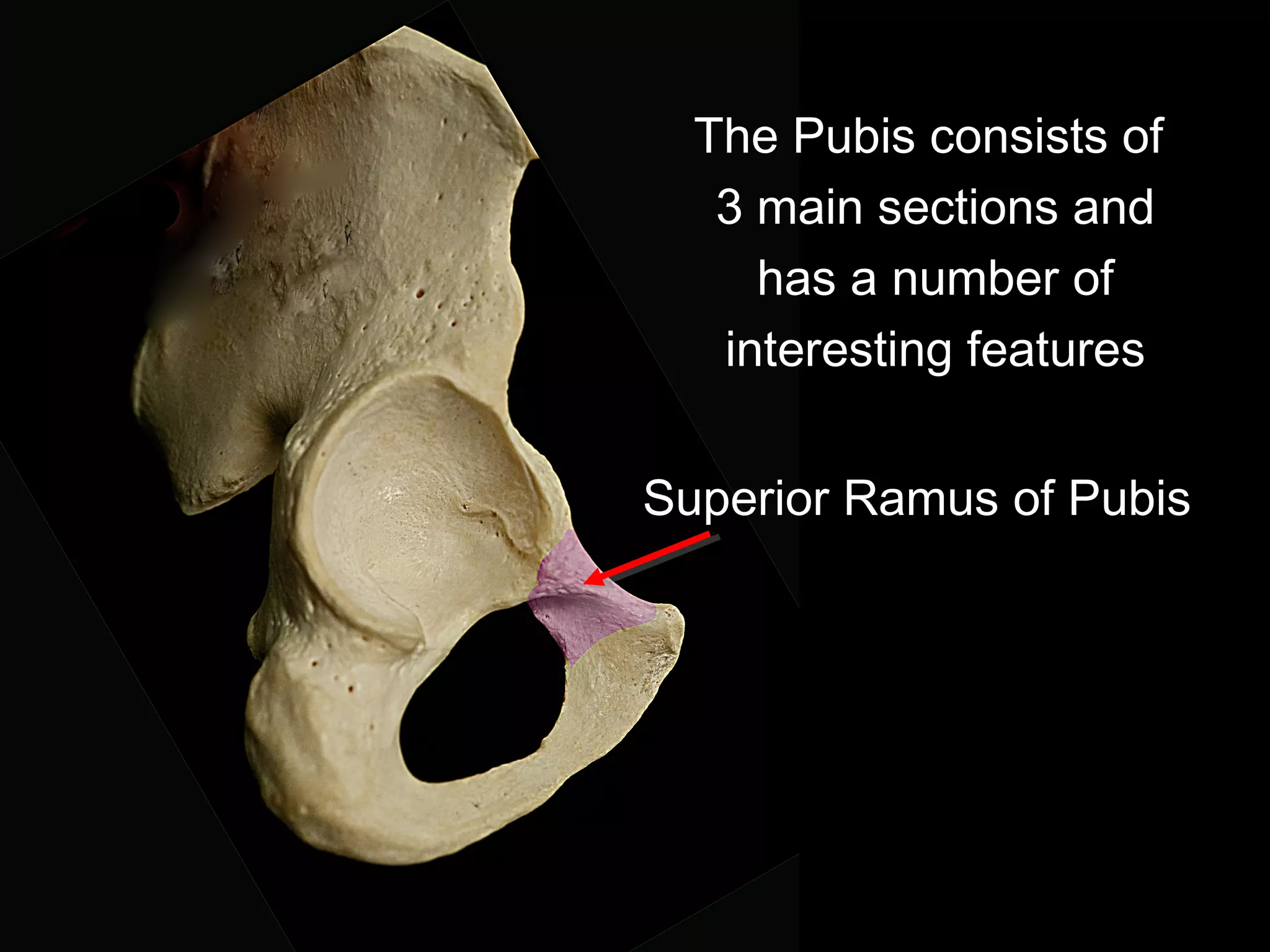 The Pubis consists of
3 main sections and
has a number of
interesting features
Superior Ramus of Pubis
 