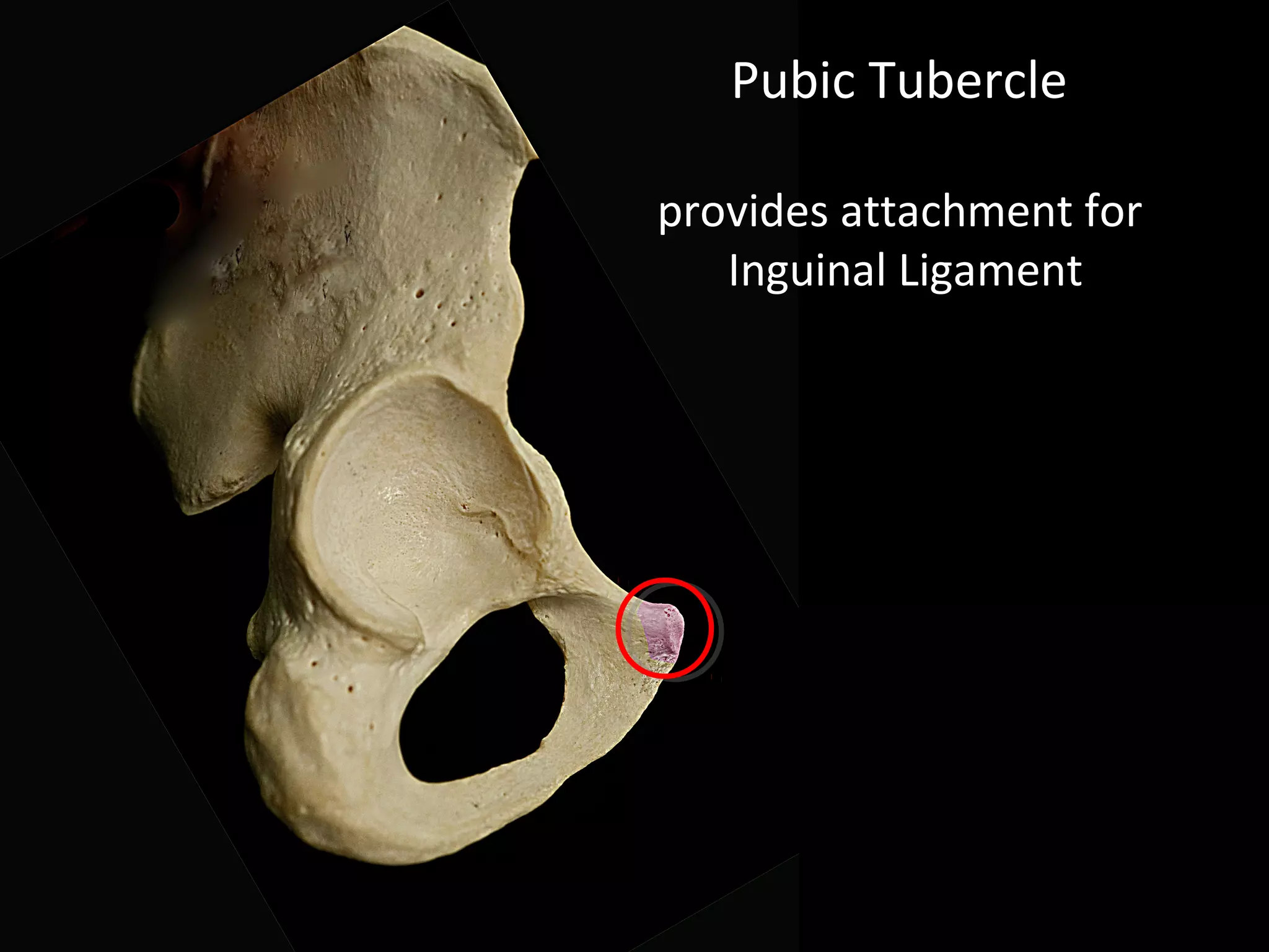 Pubic Tubercle
provides attachment for
Inguinal Ligament
 