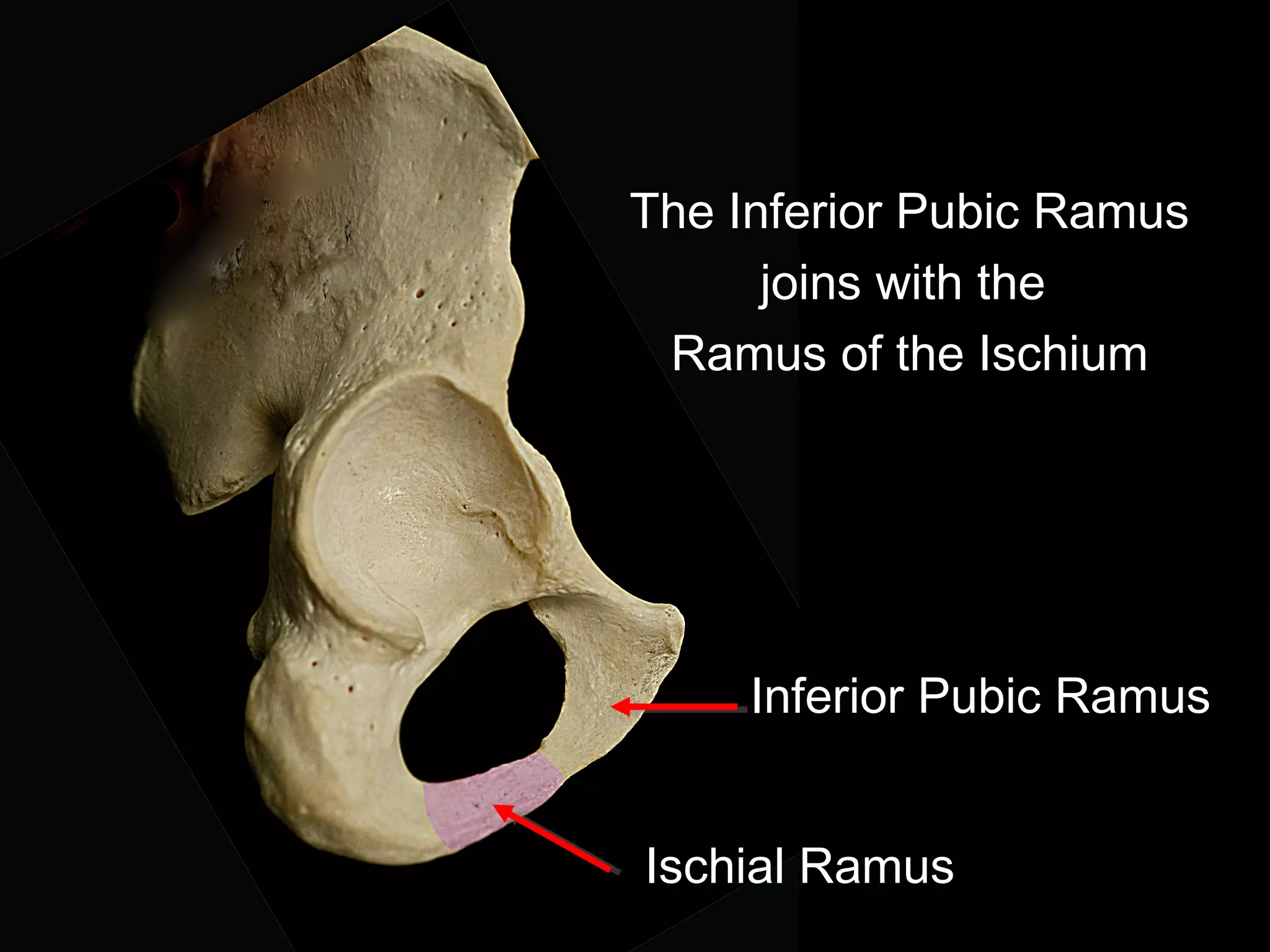The Inferior Pubic Ramus
joins with the
Ramus of the Ischium
Ischial Ramus
Inferior Pubic Ramus
 