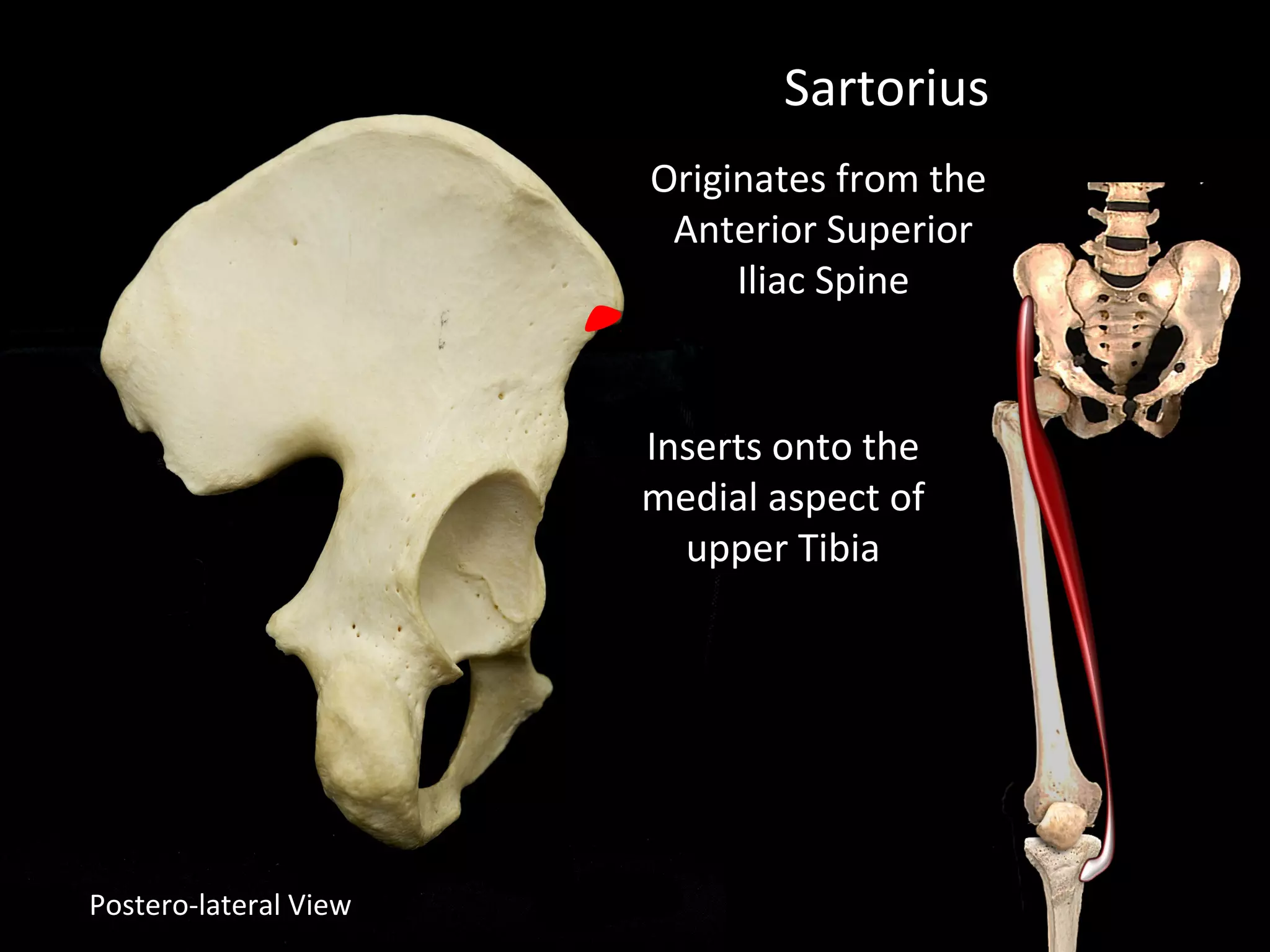 Postero-lateral View
Sartorius
Originates from the
Anterior Superior
Iliac Spine
Inserts onto the
medial aspect of
upper Tibia
 