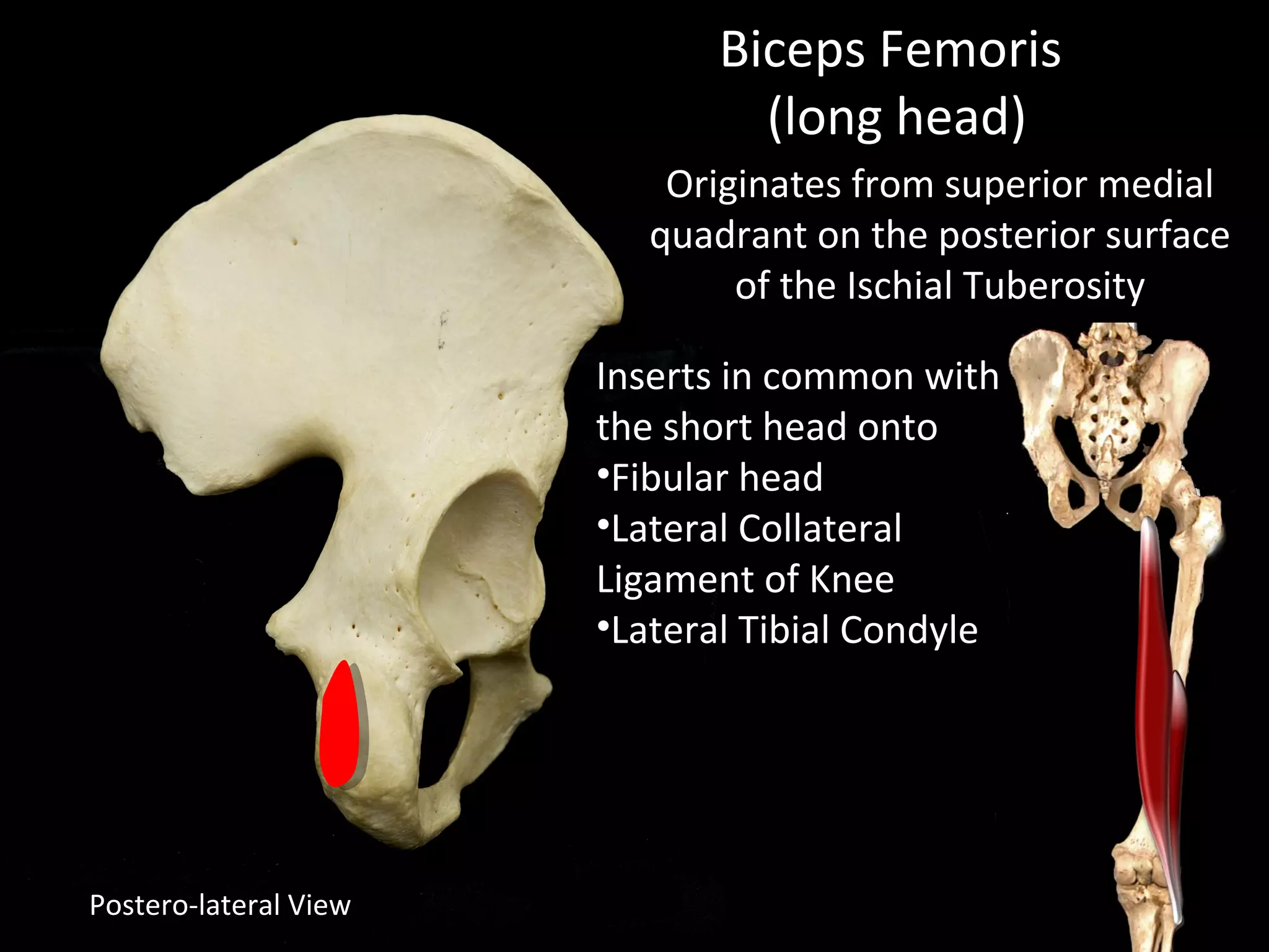 Postero-lateral View
Originates from superior medial
quadrant on the posterior surface
of the Ischial Tuberosity
Inserts in common with
the short head onto
•Fibular head
•Lateral Collateral
Ligament of Knee
•Lateral Tibial Condyle
Biceps Femoris
(long head)
 