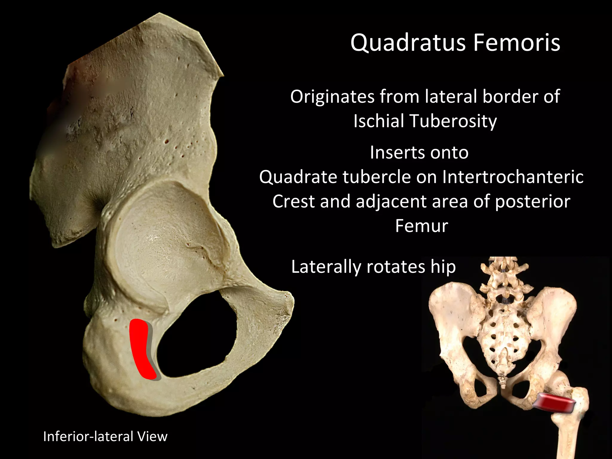 Quadratus Femoris
Originates from lateral border of
Ischial Tuberosity
Laterally rotates hip
Inferior-lateral View
Inserts onto
Quadrate tubercle on Intertrochanteric
Crest and adjacent area of posterior
Femur
 