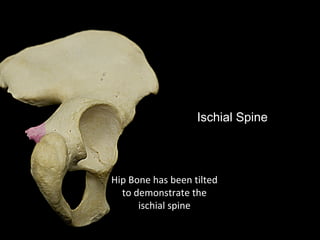 Ischial Spine
Hip Bone has been tilted
to demonstrate the
ischial spine
 