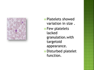  Platelets showed
variation in size .
 Few platelets
lacked
granulation.with
targetoid
appearance.
 Disturbed platelet
function.
 