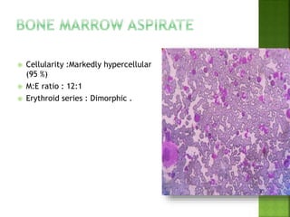 Cellularity :Markedly hypercellular
(95 %)
 M:E ratio : 12:1
 Erythroid series : Dimorphic .
 