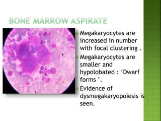  Megakaryocytes are
increased in number
with focal clustering .
 Megakaryocytes are
smaller and
hypolobated : ‘Dwarf
forms ’.
 Evidence of
dysmegakaryopoiesis is
seen.
 