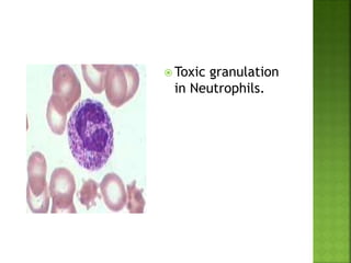  Toxic granulation
in Neutrophils.
 