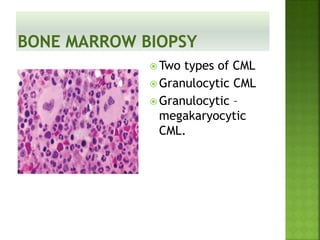  Two types of CML
 Granulocytic CML
 Granulocytic –
megakaryocytic
CML.
 