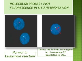 Normal in
Leukemoid reaction
Detect the BCR-ABL fusion gene
on chromosome 22
Qualitative in CML.
 