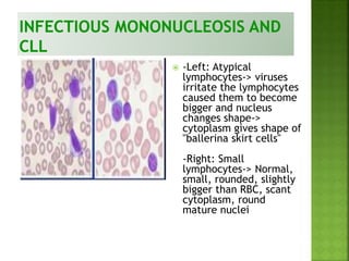  -Left: Atypical
lymphocytes-> viruses
irritate the lymphocytes
caused them to become
bigger and nucleus
changes shape->
cytoplasm gives shape of
"ballerina skirt cells"
-Right: Small
lymphocytes-> Normal,
small, rounded, slightly
bigger than RBC, scant
cytoplasm, round
mature nuclei
 