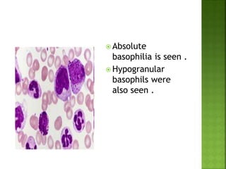  Absolute
basophilia is seen .
 Hypogranular
basophils were
also seen .
 