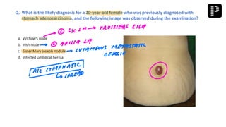 a. Virchow’s node
b. Irish node
c. Sister Mary Joseph nodule
d. Infected umbilical hernia
Q. What is the likely diagnosis for a 20-year-old female who was previously diagnosed with
stomach adenocarcinoma, and the following image was observed during the examination?
 