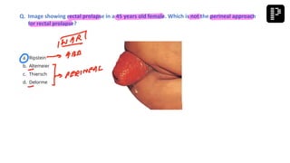 a. Ripstein
b. Altemeier
c. Thiersch
d. Delorme
Q. Image showing rectal prolapse in a 45 years old female. Which is not the perineal approach
for rectal prolapse?
 