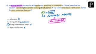 a. Adhesions
b. Strangulated inguinal hernia
c. Strangulated femoral hernia
d. Appendicular mass
Q. A young female presenting with pain and vomiting in emergency. Clinical examination
reveals a swelling lateral and below pubic tubercle. X-ray shows intestinal obstruction. What
is most probable diagnosis?
 