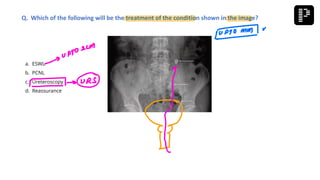 a. ESWL
b. PCNL
c. Ureteroscopy
d. Reassurance
Q. Which of the following will be the treatment of the condition shown in the image?
 
