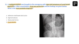 a. Adhesive small bowel obstruction
b. Sigmoid volvulus
c. Obstructed hernia
d. Cecal volvulus
Q. A multipara patient was brought to the emergency with signs and symptoms of small bowel
obstruction. After resuscitation, X-ray was performed and the findings are given below.
What is the most probable diagnosis?
 