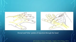 Pip Volar Injection WALANT -Wide Awake Local Anesthesia No Tourniquet Surgery Technique | PPTX