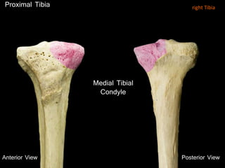 Proximal Tibia
Anterior View
Medial Tibial
Condyle
Posterior View
right Tibia
 