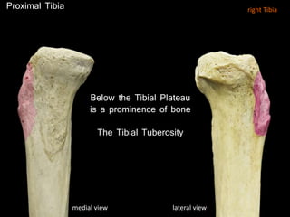 Proximal Tibia
Below the Tibial Plateau
is a prominence of bone
The Tibial Tuberosity
medial view lateral view
right Tibia
 