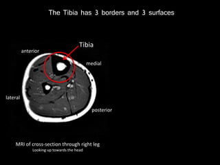 The Tibia has 3 borders and 3 surfaces
MRI of cross-section through right leg
Looking up towards the head
Tibia
anterior
posterior
medial
lateral
 